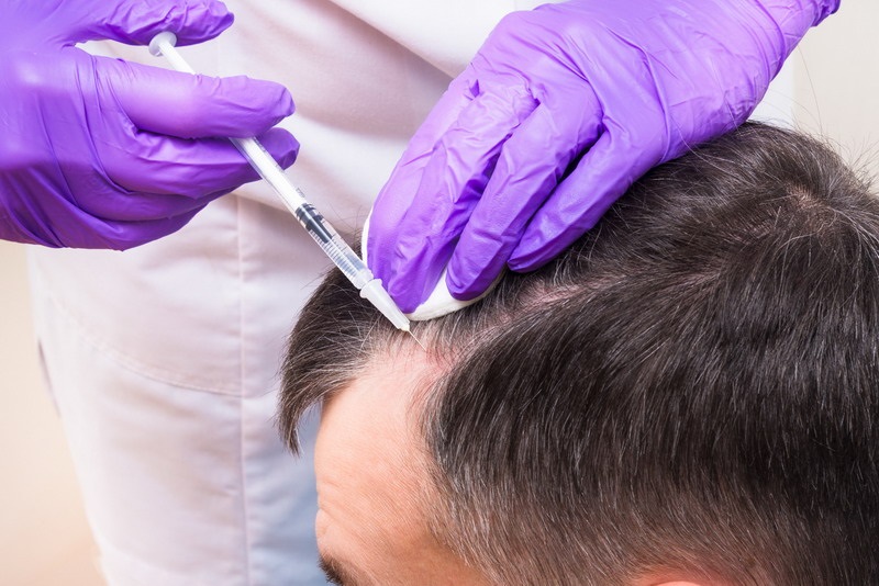 Would You Go ‘Under the Needle’ to Treat Hair Loss?