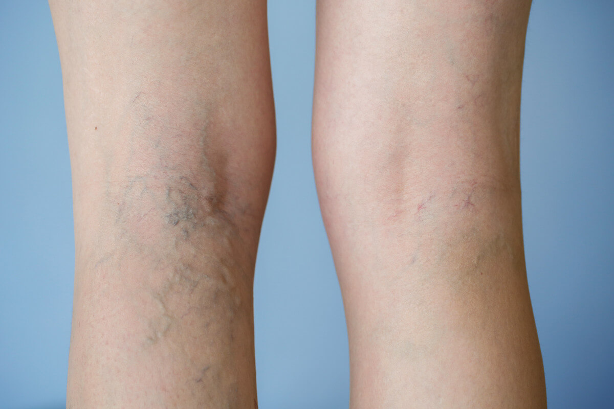 Varicose Veins—What Are Their Causes? 